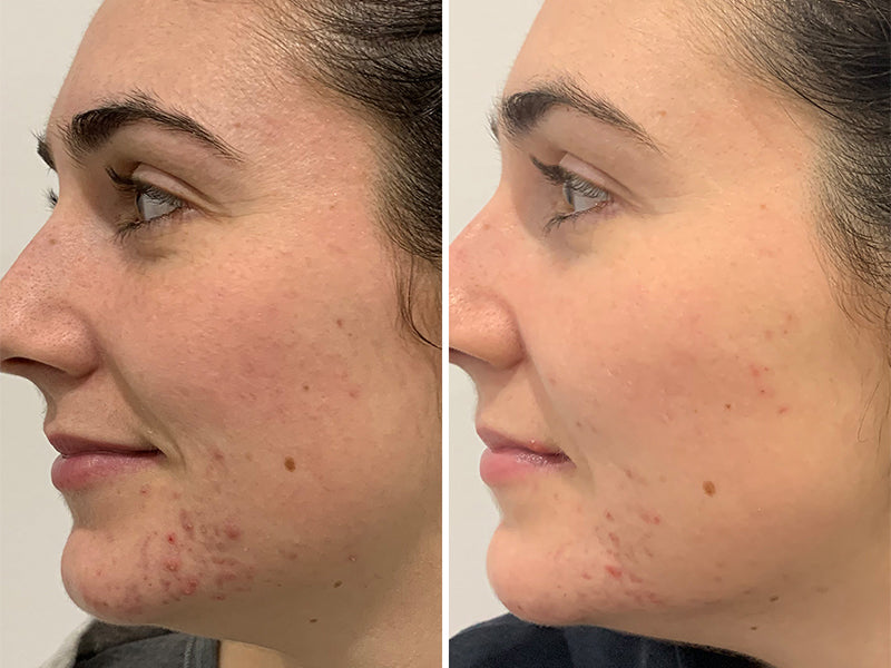Trial Tribe reviews: Kate’s Clear Skin Journey