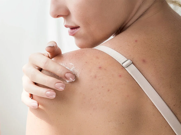 Body breakout causes and how to treat them